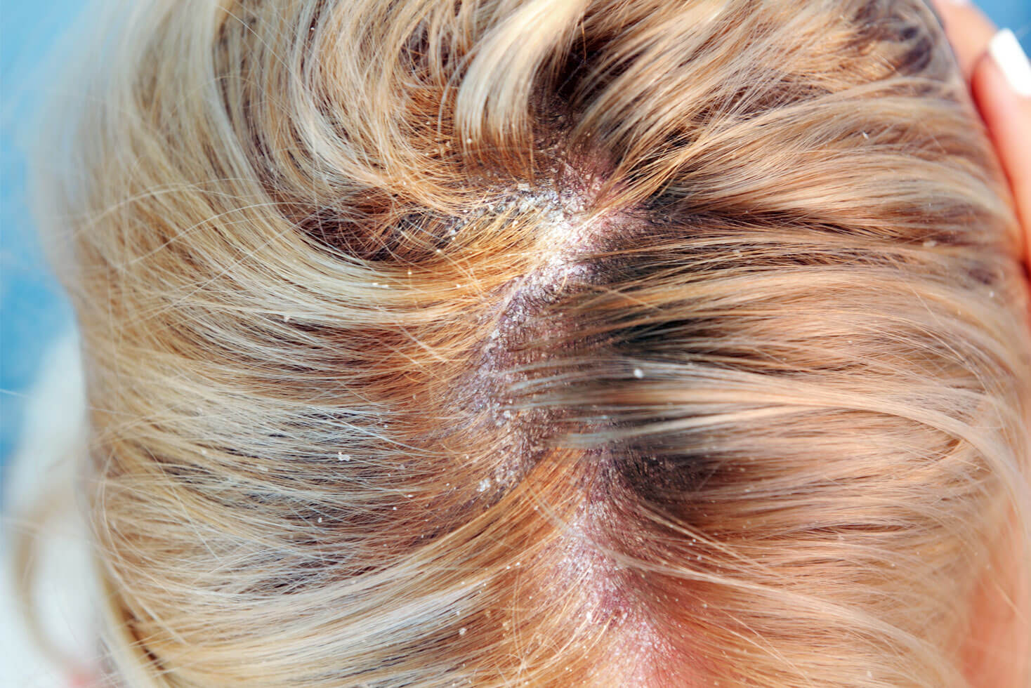 what causes scalp fungus