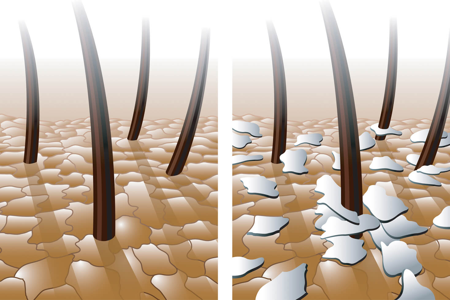 Calcium Buildup in Hair – The Sneaky Culprit Choking Your Follicles