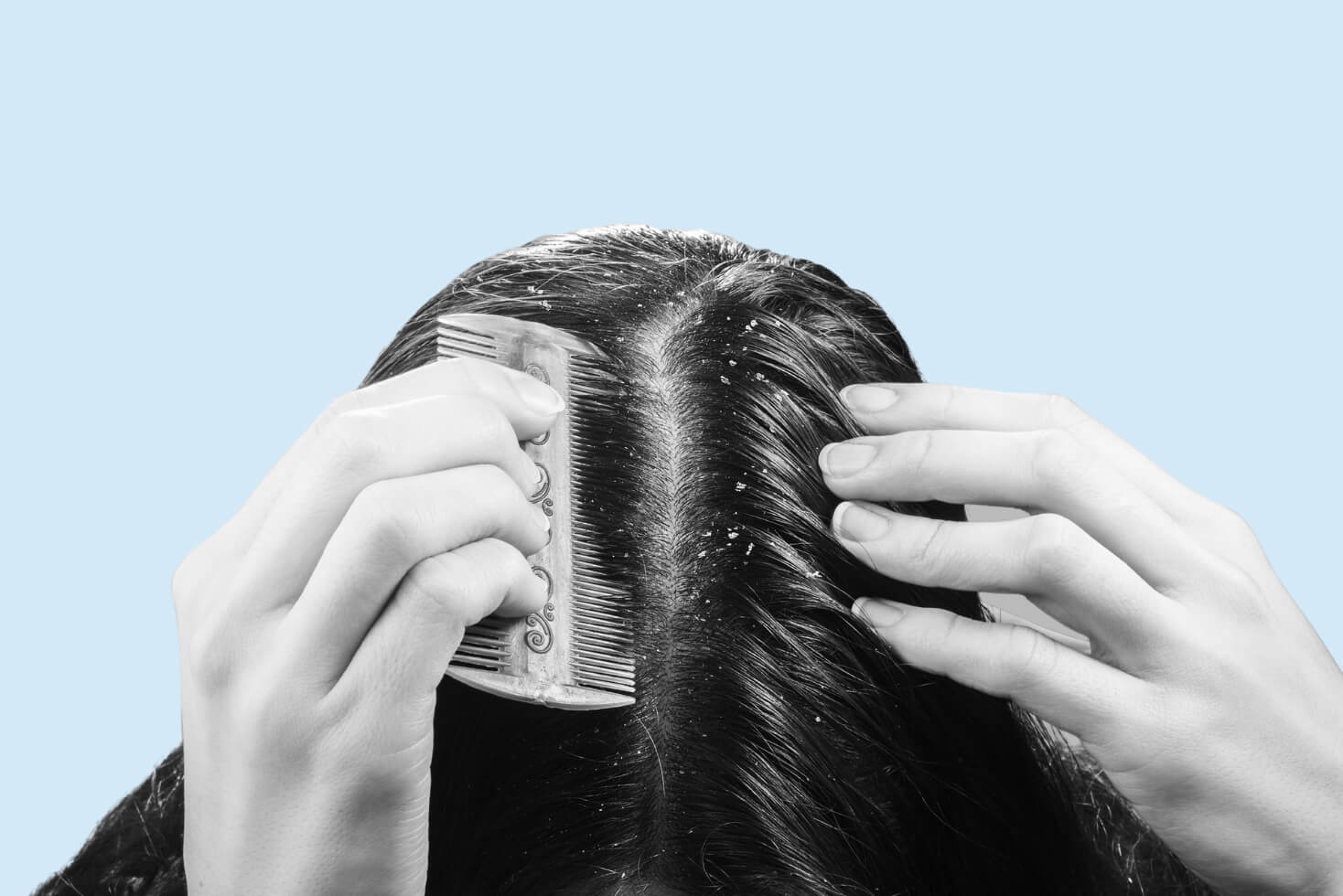 4 Best Dandruff Combs for A Flake-Free Scalp Without Scraping