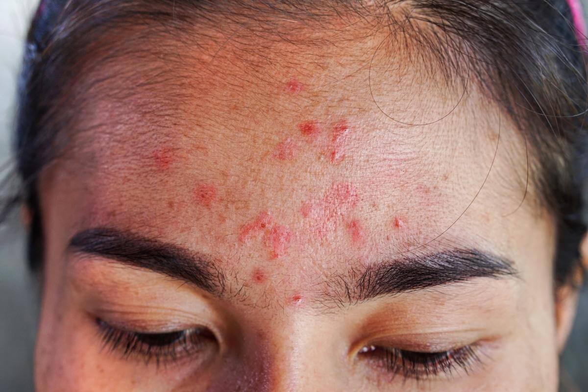 signs that your hair dye contains chemicals that may cause allergic reactions